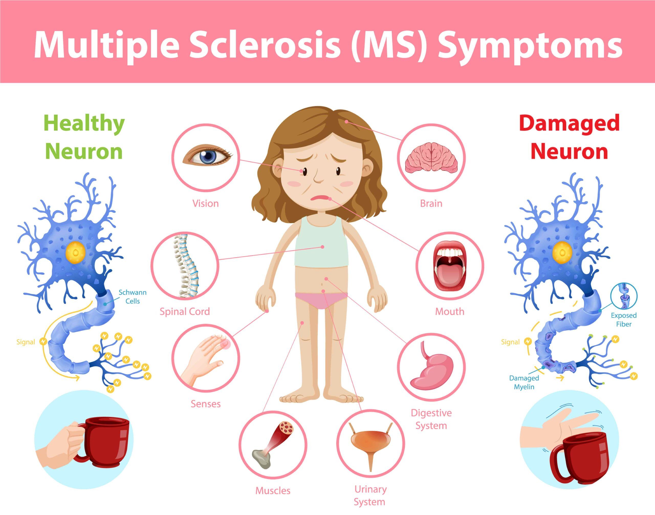 Infographic - Multiple Sclerosis